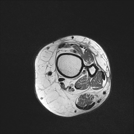 File:Anterior talofibular ligament injury - rupture with soft-tissue impingement (Radiopaedia 38765-40928 Axial PD 1).jpg