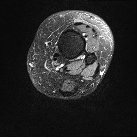 File:Anterior talofibular ligament injury - rupture with soft-tissue impingement (Radiopaedia 38765-40928 D 2).jpg