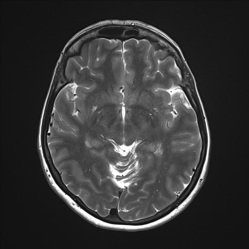 File:Anterior temporal encephalocele (Radiopaedia 82624-96808 Axial T2 17).jpg