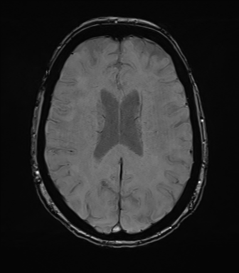 Anterior temporal pole cysts (Radiopaedia 46629-51102 Axial SWI 55).png