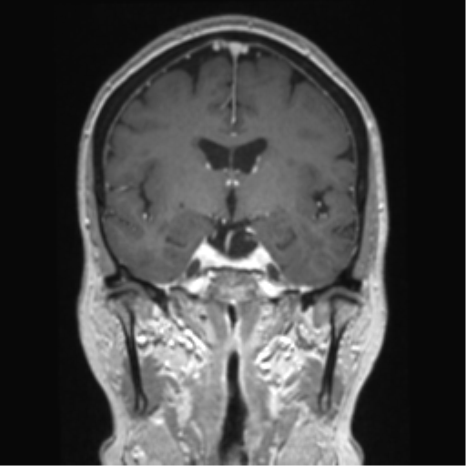 Anterior temporal pole cysts (Radiopaedia 46629-51102 Coronal T1 C+ 95).png