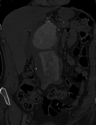 Anterior vertebral scalloping (abdominal aortic aneurysm) (Radiopaedia 66744-76067 Coronal bone window 5).jpg