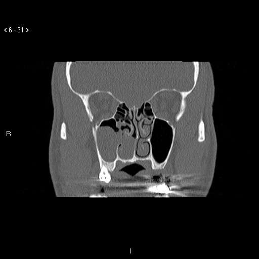 File:Antrochoanal Polyp (Radiopaedia 70510-80631 Coronal bone window 20).jpg