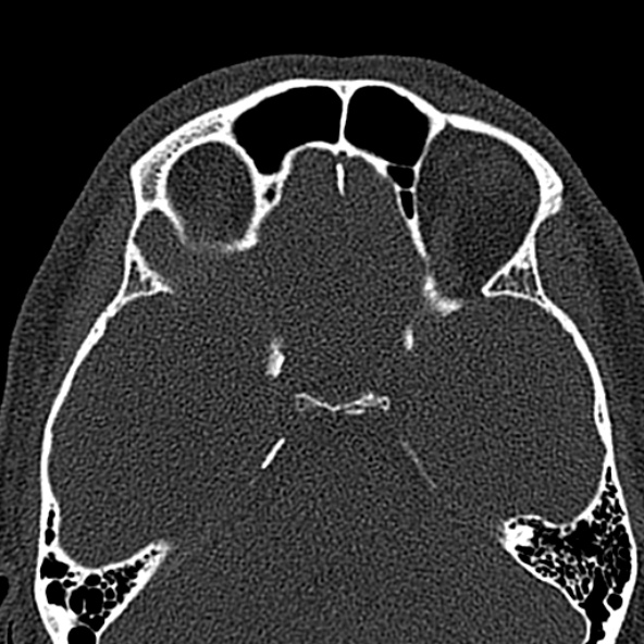 Antrochoanal polyp (Radiopaedia 30002-30554 Axial bone window 46).jpg