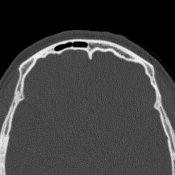 Antrochoanal polyp (Radiopaedia 33984-35202 Axial bone window 77).jpg