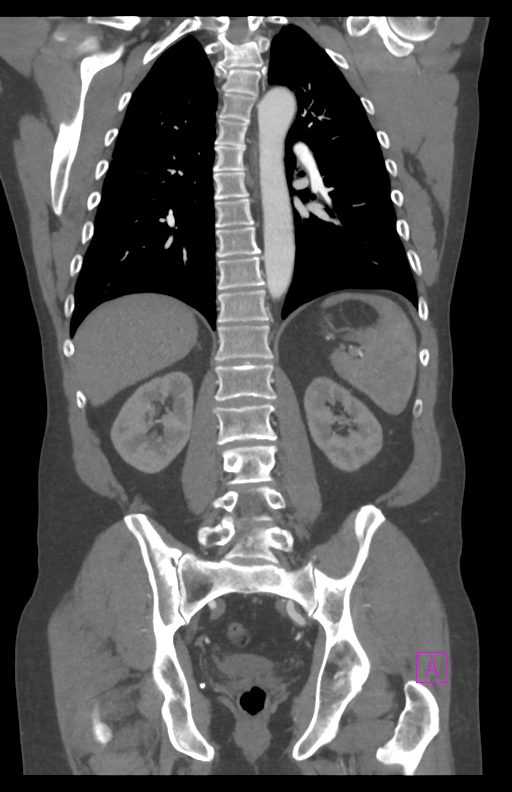 Aortectomy and axillary-bifemoral bypass (Radiopaedia 28303-28545 C 62).jpg