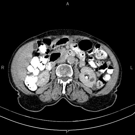 Aortic aneurysm and Lemmel syndrome (Radiopaedia 86499-102554 Axial C+ delayed 37).jpg