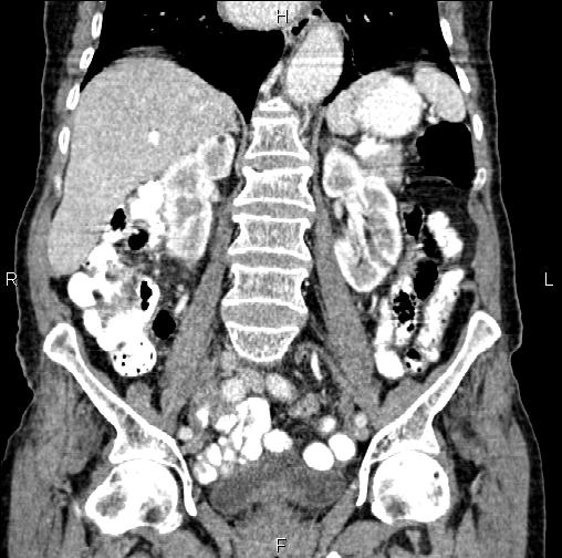 Aortic aneurysm and Lemmel syndrome (Radiopaedia 86499-102554 C 35).jpg