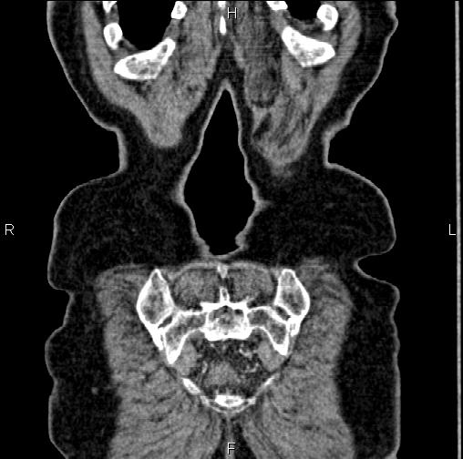 Aortic aneurysm and Lemmel syndrome (Radiopaedia 86499-102554 C 64).jpg