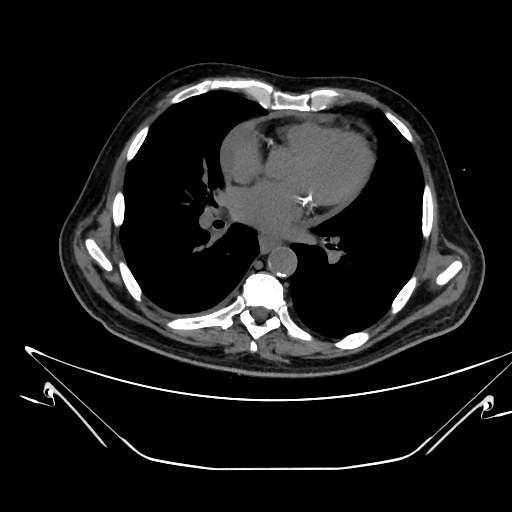 File:Aortic arch aneurysm (Radiopaedia 84109-99365 Axial non-contrast 160).jpg