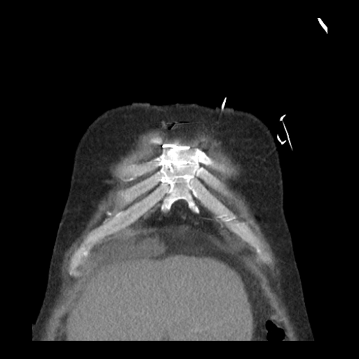 Aortic arch graft infection (FDG PET-CT) (Radiopaedia 71975-82437 Coronal 9).jpg