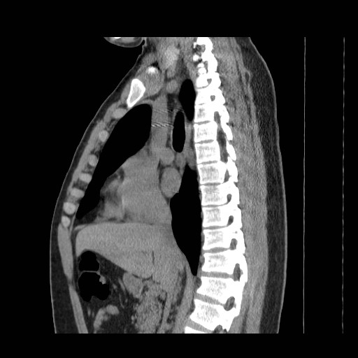 File:Aortic arch stent (Radiopaedia 30030-30595 B 4).jpg