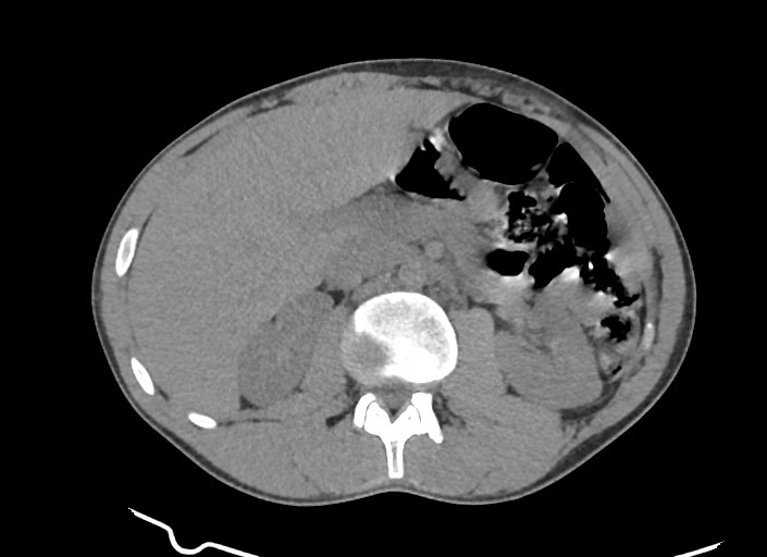 File:Aortic coarctation with aneurysm (Radiopaedia 74818-85828 A 12).jpg