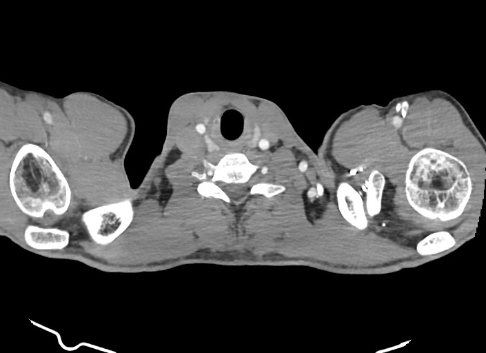 File:Aortic coarctation with aneurysm (Radiopaedia 74818-85828 A 194).jpg