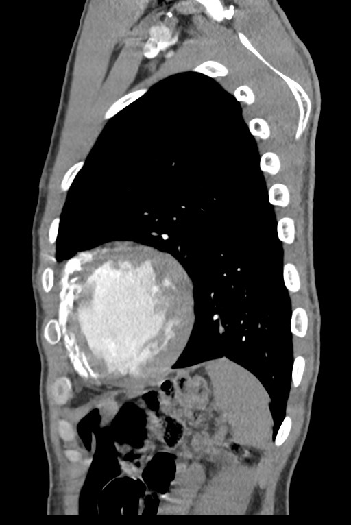 Aortic coarctation with aneurysm (Radiopaedia 74818-85828 B 130).jpg