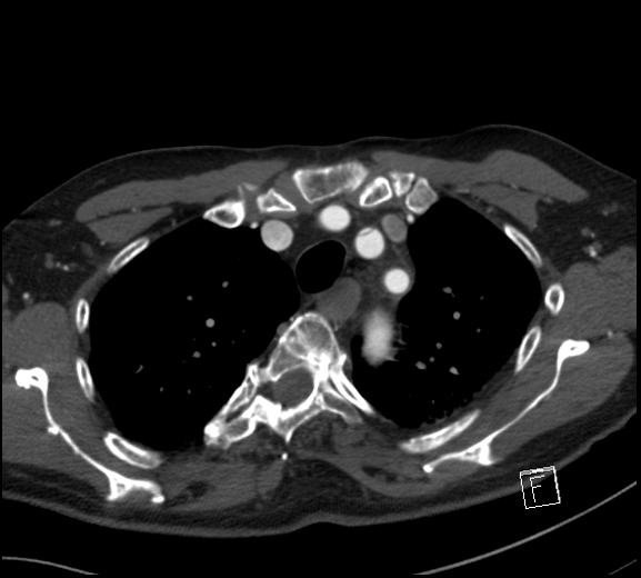 File:Aortic dissection (CTPA) (Radiopaedia 75506-86750 A 21).jpg