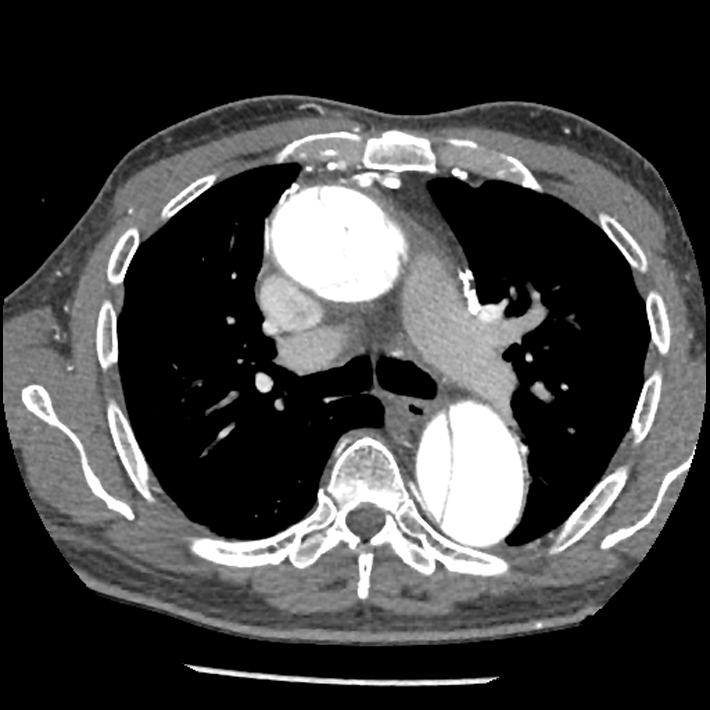 Aortic dissection - DeBakey Type I-Stanford A (Radiopaedia 79863-93115 A 14).jpg