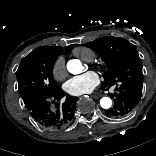 Aortic dissection - DeBakey type II (Radiopaedia 64302-73082 A 53).png