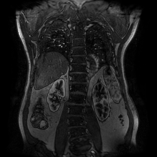 File:Aortic dissection - Stanford A - DeBakey I (Radiopaedia 23469-23551 D 186).jpg
