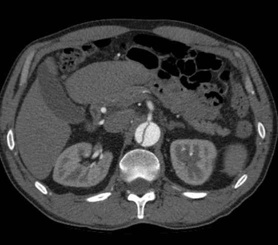 File:Aortic dissection - Stanford type B (Radiopaedia 73648-84437 A 133).jpg