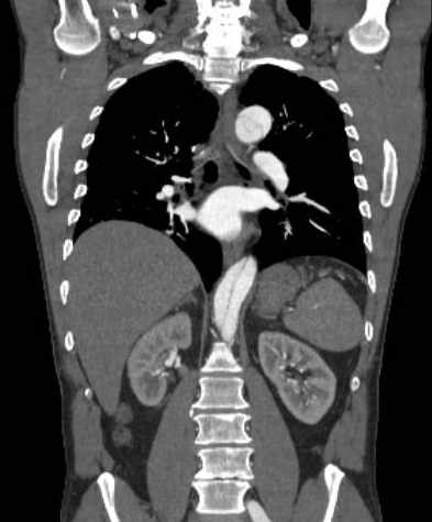 File:Aortic dissection - Stanford type B (Radiopaedia 73648-84437 B 73).jpg