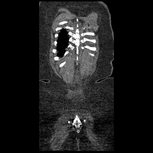 File:Aortic dissection - Stanford type B (Radiopaedia 88281-104910 B 86).jpg