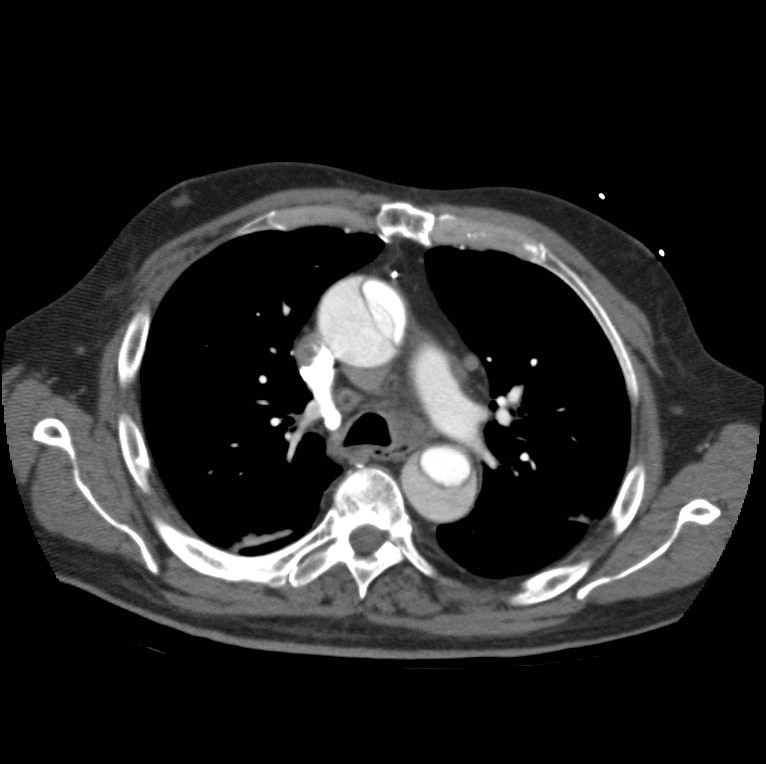 Aortic dissection with rupture into pericardium (Radiopaedia 12384-12647 A 21).jpg