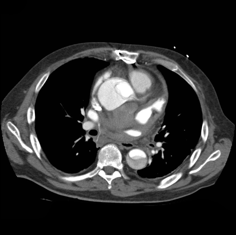 Aortic dissection with rupture into pericardium (Radiopaedia 12384-12647 A 29).jpg