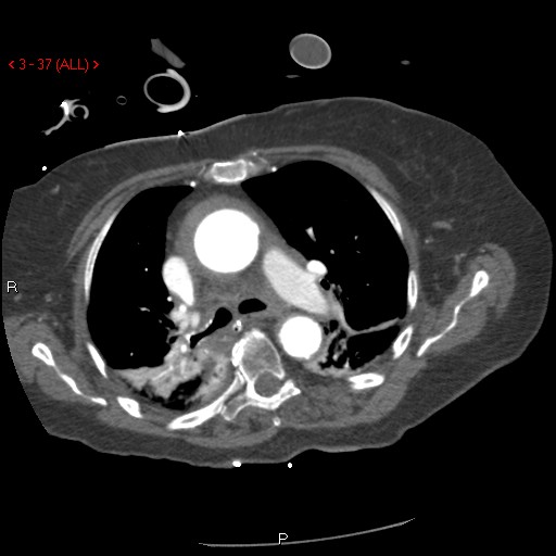 Aortic intramural hematoma (Radiopaedia 27746-28001 A 37).jpg