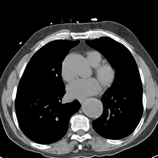 Aortic intramural hematoma (Radiopaedia 31139-31838 Axial non-contrast 34).jpg