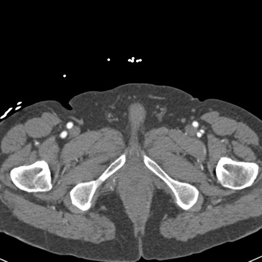 Aortic intramural hematoma (Radiopaedia 31139-31838 B 178).jpg