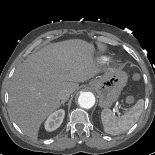 Aortic intramural hematoma (Radiopaedia 31139-31838 B 78).jpg