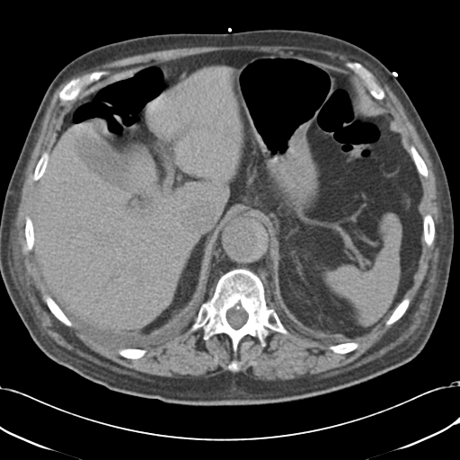 Aortic intramural hematoma (Radiopaedia 34260-35540 Axial non-contrast 57).png