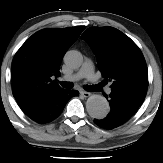 Aortic intramural hematoma (type B) (Radiopaedia 79323-92387 Axial non-contrast 22).jpg
