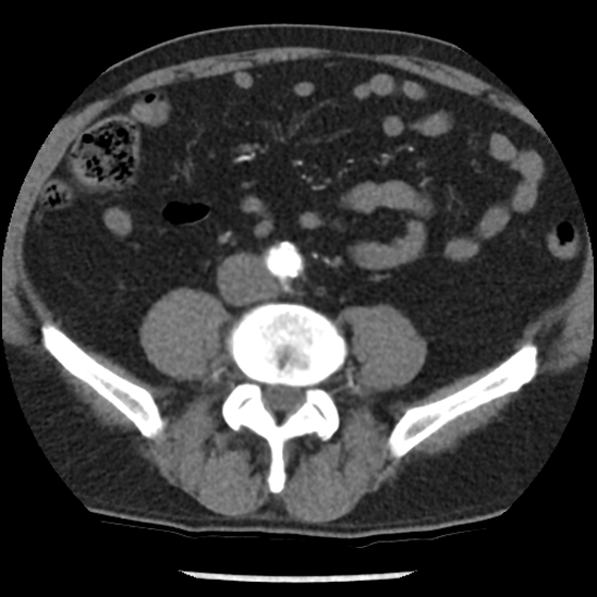 File:Aortic intramural hematoma (type B) (Radiopaedia 79323-92387 B 84).jpg