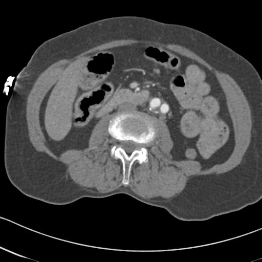 Aortic intramural hematoma from penetrating atherosclerotic ulcer (Radiopaedia 31137-31836 A 113).jpg