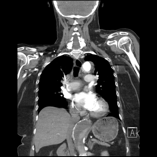 Aortic intramural hematoma with dissection and intramural blood pool (Radiopaedia 77373-89491 C 32).jpg
