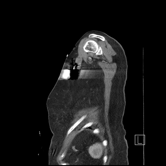 Aortic intramural hematoma with dissection and intramural blood pool (Radiopaedia 77373-89491 D 85).jpg