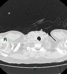 File:Aortic valve endocarditis (Radiopaedia 87209-103485 Axial lung window 8).jpg
