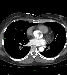 File:Aortic valve endocarditis (Radiopaedia 87209-103485 C 54).jpg