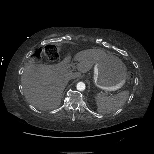 Aortoesophageal fistula with endovascular repair (Radiopaedia 73781-84592 Axial C+ CTPA 161).jpg