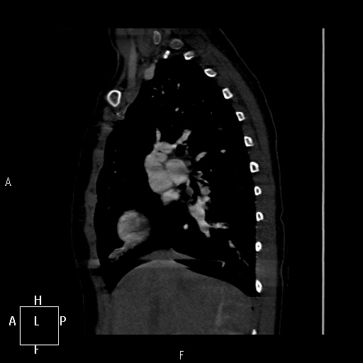 File:Aortopulmonary septal defect (Radiopaedia 41990-45013 Sagittal C+ CTPA 42).jpg