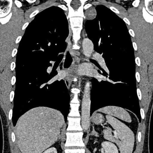 File:Apical lung mass mimic - neurogenic tumor (Radiopaedia 59918-67521 B 71).jpg