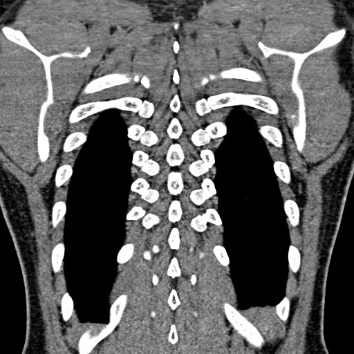 Apical lung mass mimic - neurogenic tumor (Radiopaedia 59918-67521 B 92).jpg