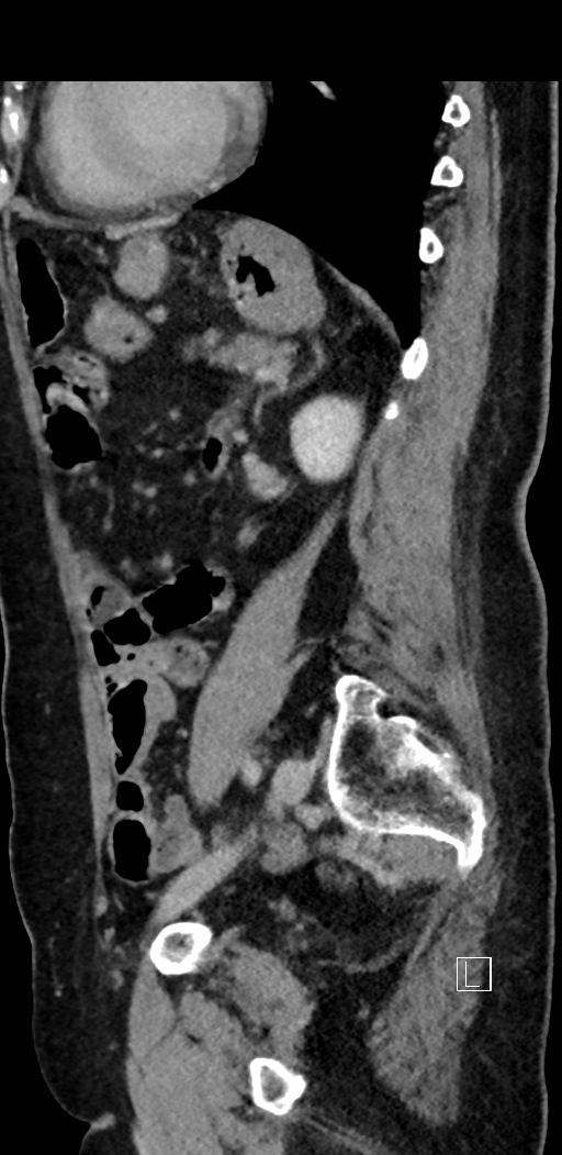 Appendiceal hemorrhage (Radiopaedia 70830-81025 Sagittal C+ delayed 72).jpg