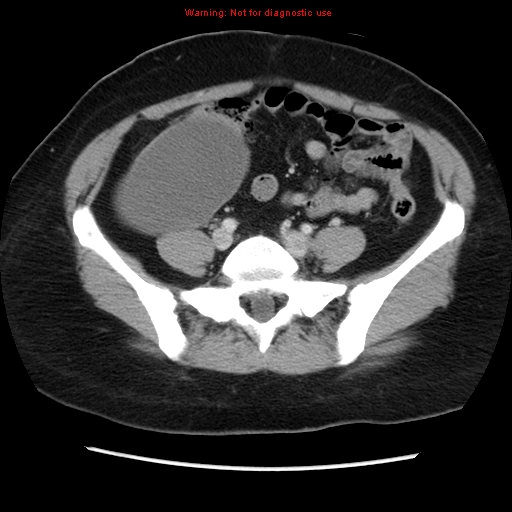 Appendiceal mucinous cystadenoma (Radiopaedia 8263-9111 Axial liver window 57).jpg