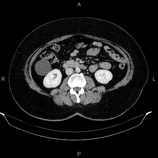 Appendiceal mucocele (Radiopaedia 83280-97688 Axial With contrast 54).jpg