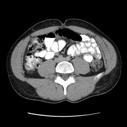 Appendicitis complicated by post-operative collection (Radiopaedia 35595-37113 A 44).jpg