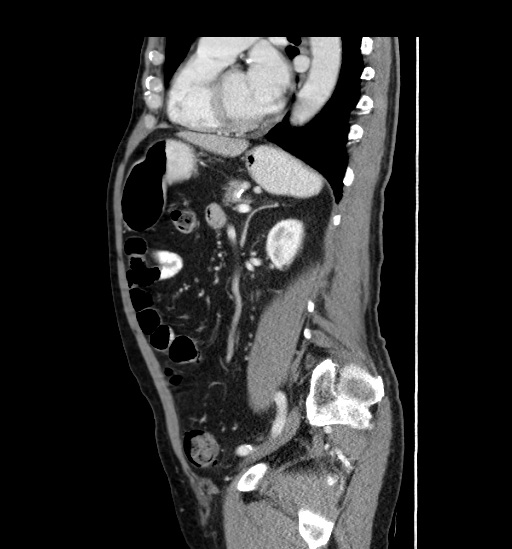 Appendicitis with localized perforation and abscess formation (Radiopaedia 49035-54130 C 41).jpg