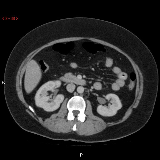 Appendicitis with microperforation- promontoric type (Radiopaedia 27268-27442 C 26).jpg